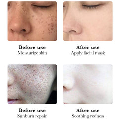 Niacinamide Whitening Spot Mask for Dark Spots and Hydration